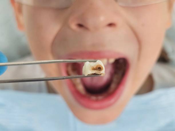 Best Tooth Infection Emergency Dentist  in Young Harris, GA